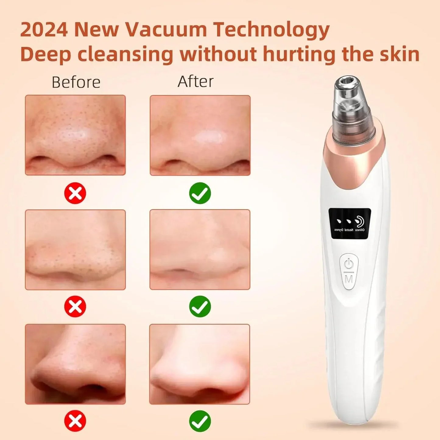 Blackhead Remover Tool for Clear Skin (Pore Vacuum Cleaner)