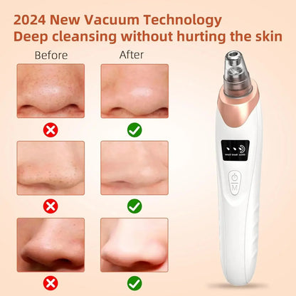 Blackhead Remover Tool for Clear Skin (Pore Vacuum Cleaner)