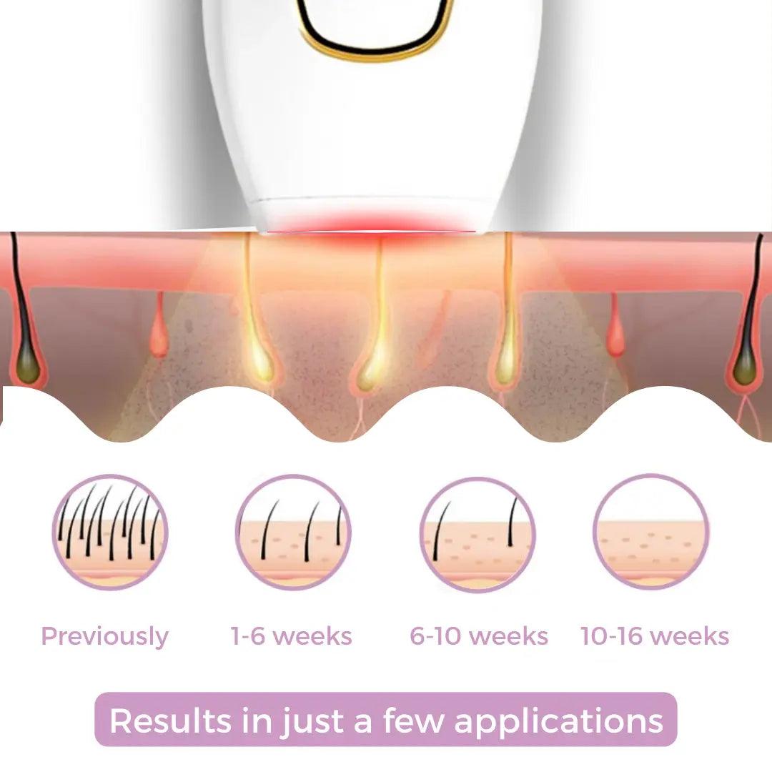 Luxiz™ IPL Hair Remover I The leading laser hair removal for your home Phoera™️