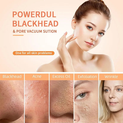 Blackhead Remover Tool for Clear Skin (Pore Vacuum Cleaner)