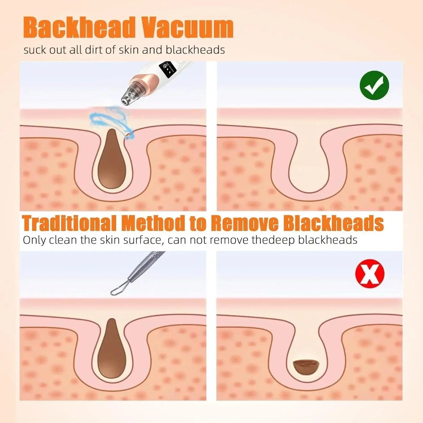 Blackhead Remover Tool for Clear Skin (Pore Vacuum Cleaner)
